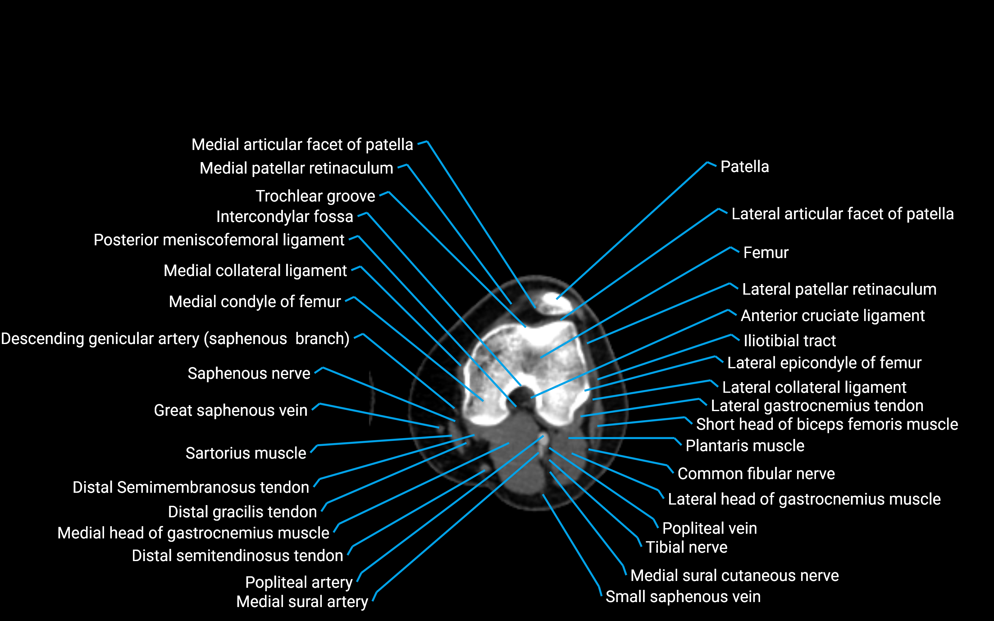CT Lower leg axial cross sectional anatomy labelled image 86 (2).png